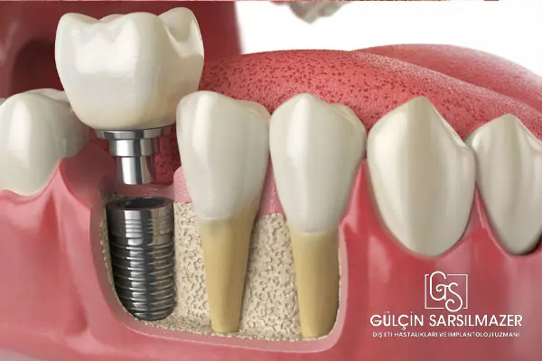 implant tedavisi fiyatı
