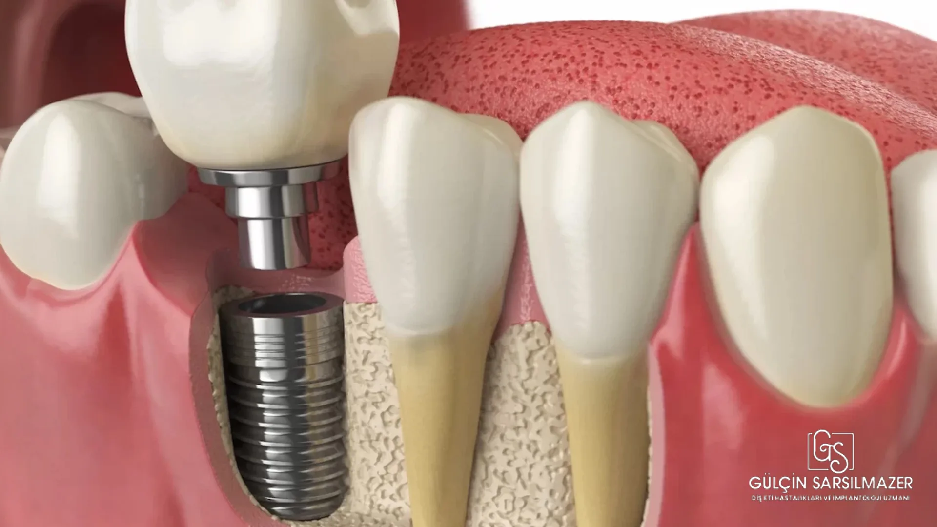 implant-vidası-düşer-mi