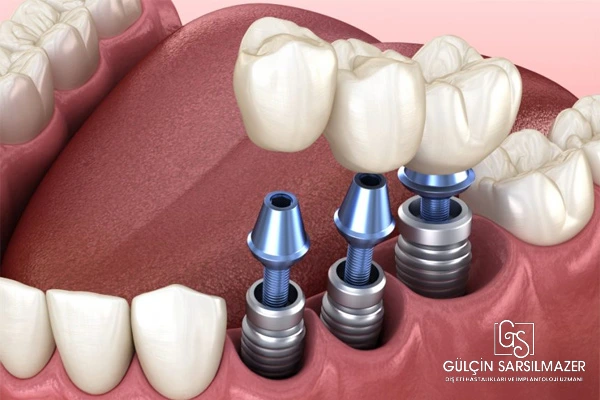 implant vidası düşer mi