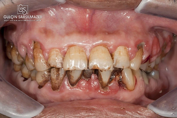periodontitis nasıl tedavi edilir