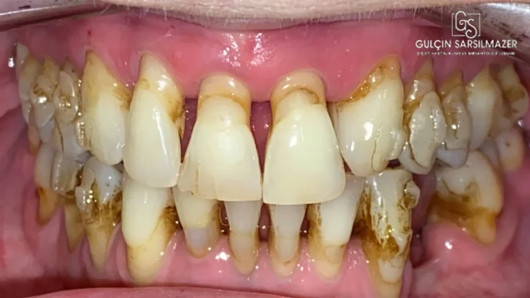periodontitis-nasıl-tedavi-edilir