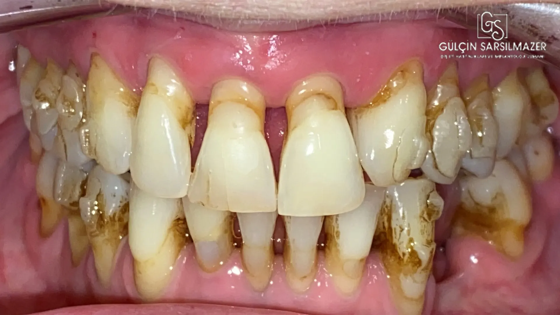 periodontitis-nasıl-tedavi-edilir