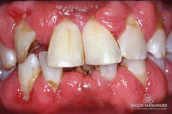 periodontitis