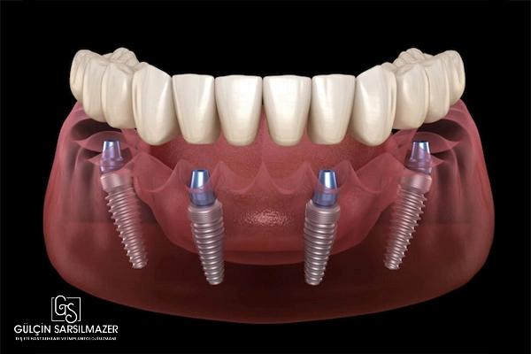 all on four implant tekniği