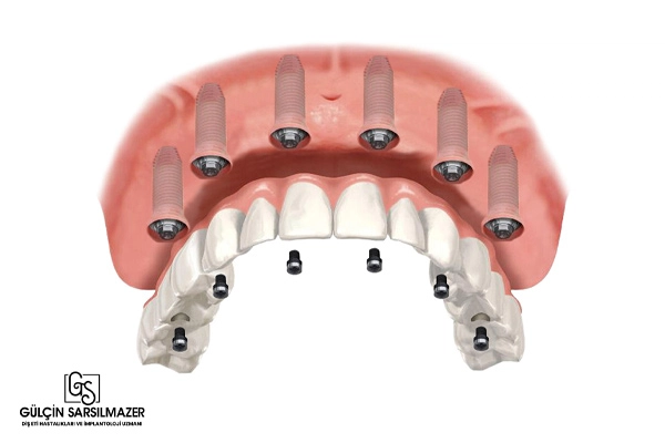 all on six implant tekniği