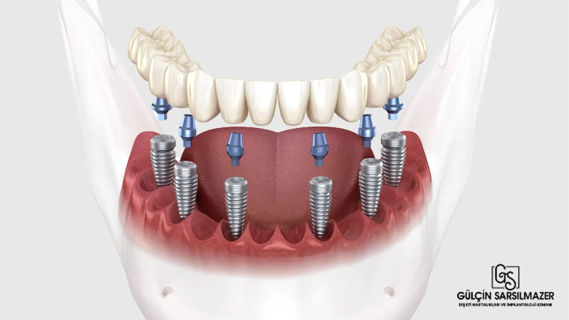 all-on-six-implant-tekniği