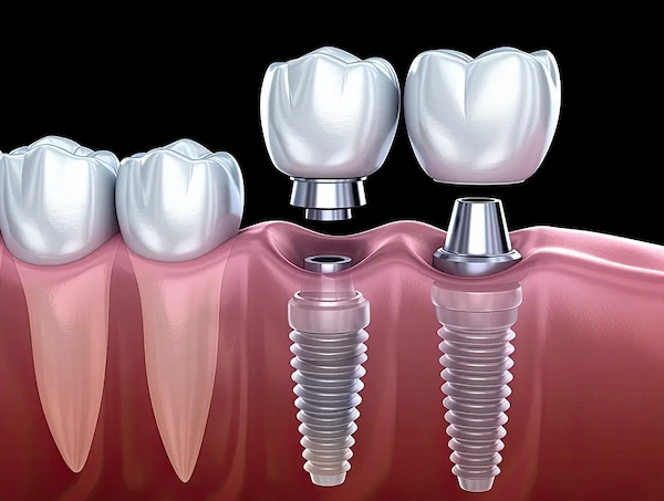 dental implant