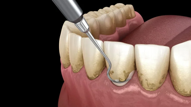 diş eti çekilmesinde implant yapılır mı