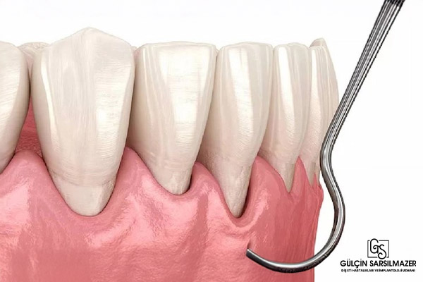 diş eti çekilmesinde implant yapılır mı