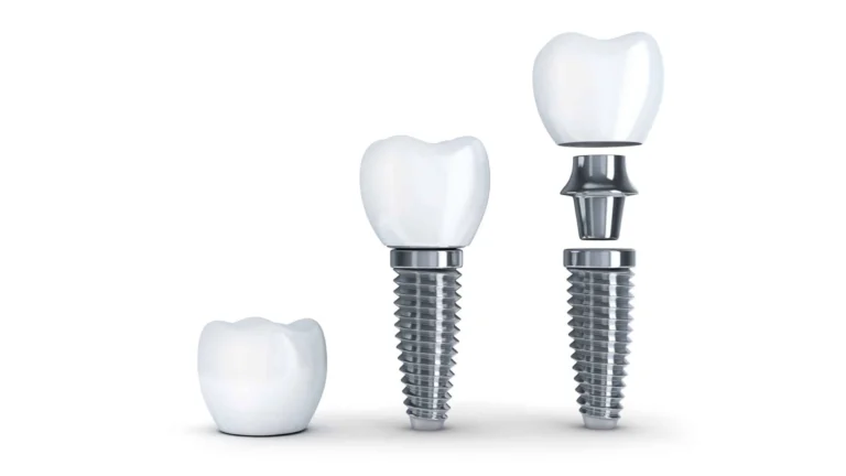 implant sonrası çene ağrısı olur mu