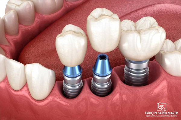 implant tedavisi