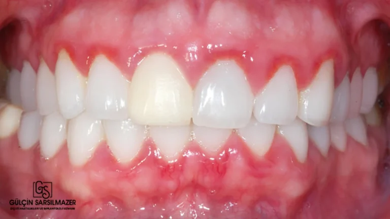 Diş Eti Hastalıkları (Periodontal Hastalık) Nelerdir Neden Oluşur