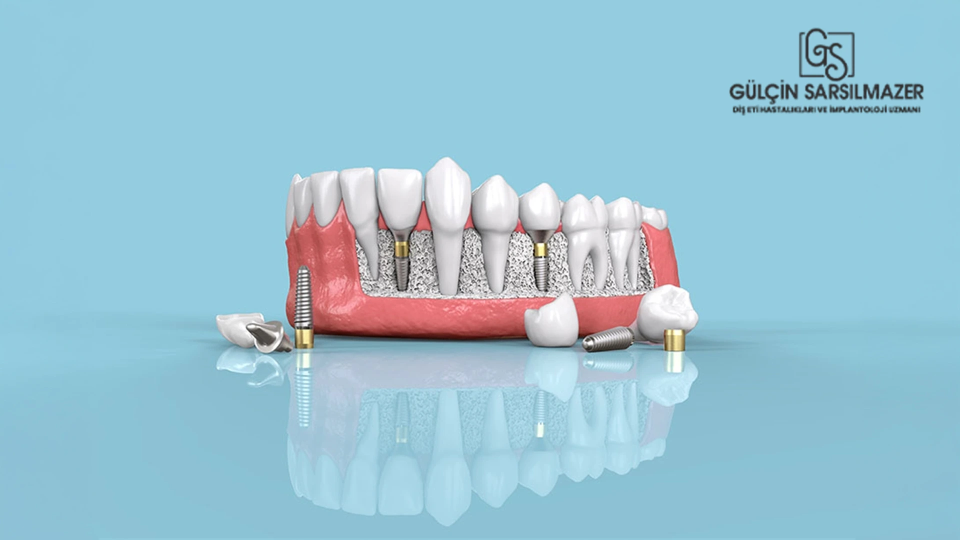 implant sökülebilir mi