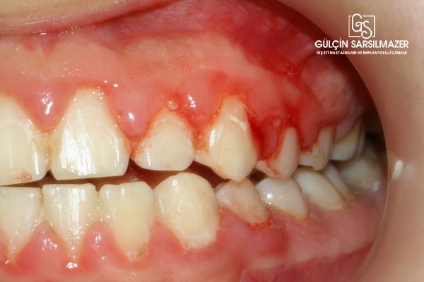 Periodontitis-Evreleri-ve-Türleri