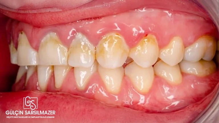 Periodontitis-evreleri-ve-türleri
