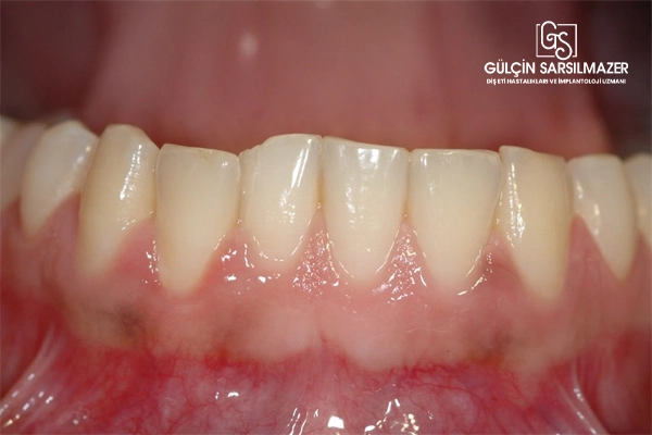 Periodontitis evreleri ve türleri