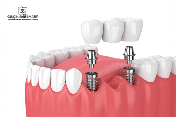 implant tedavisi