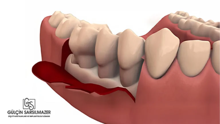 Diş-Eti-Flap-Operasyonu-Nedir