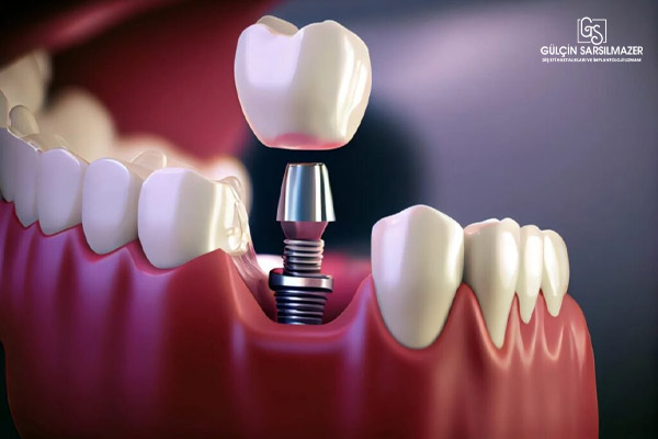 implant diş