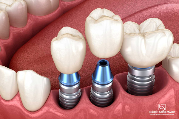 Çene kemiğine yerleştirilmiş üçlü diş implantı sistemi