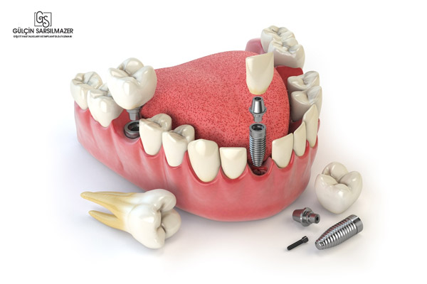 Alt çeneye uygulanan diş implantı işlemini gösteren 3D model