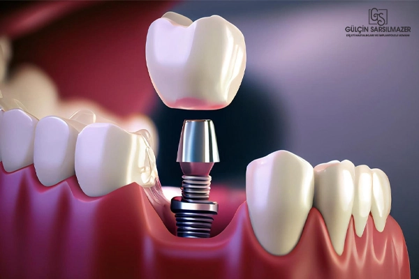 Diş implantı uygulaması 3D görseli