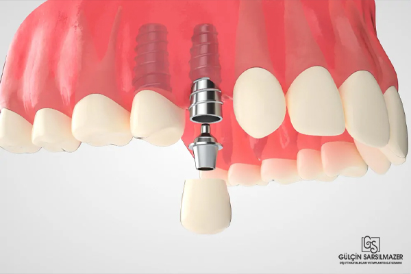 Üst çeneye uygulanan diş implantı
