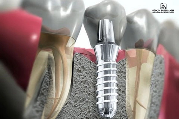 Diş eti ve kemik yapısı kesiti üzerinde gösterilen diş implantı ve komşu doğal dişlerle birlikte 3D model görseli