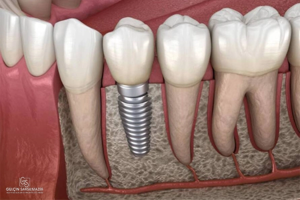 Çene kemiğine yerleştirilmiş diş implantını ve çevresindeki doğal dişleri gösteren 3D dental görsel