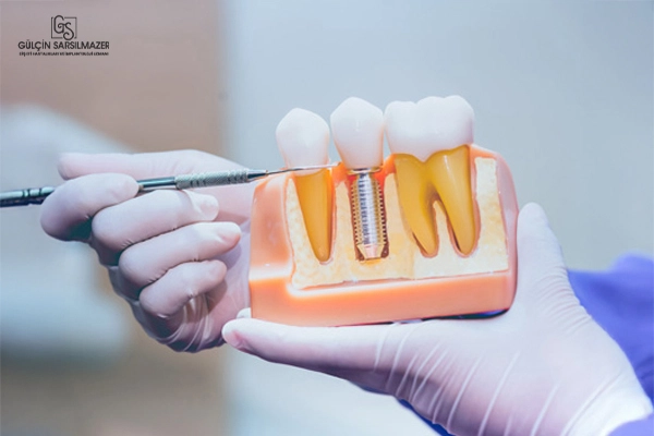 Diş hekimi elinde implant uygulamasını gösteren anatomik model tutuyor