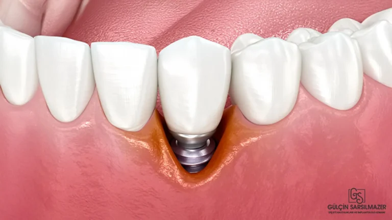 Periimplantitis-İmplant-İltihabı-Nedir