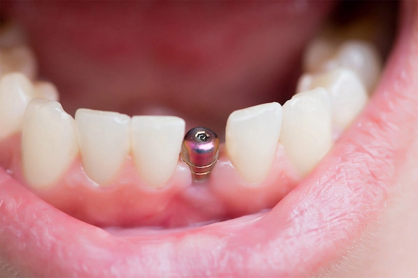 Ağız içinde alt çene ön bölgesine yerleştirilmiş diş implantı vidasının yakın çekimi