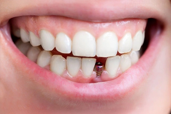 Ön diş bölgesine yerleştirilmiş dental implant vidası görülen bir hastanın gülümseme fotoğrafı