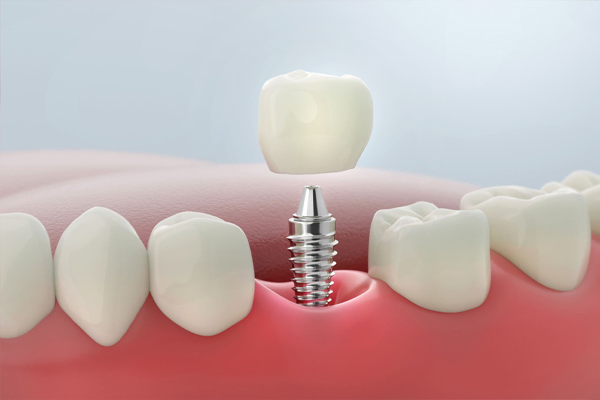 Diş eti içine yerleştirilmiş titanyum implant üzerine porselen diş kronu yerleştirilmesini gösteren 3D dental implant görseli