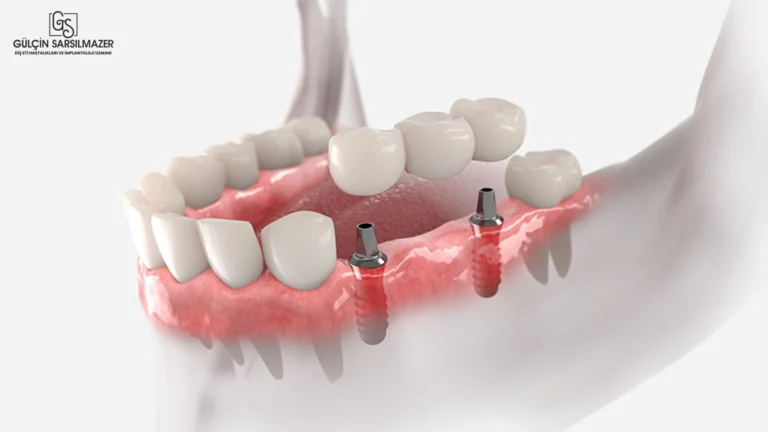 Alt çenede yerleştirilen implantlar üzerine desteklenen hareketli protezi gösteren 3D görsel