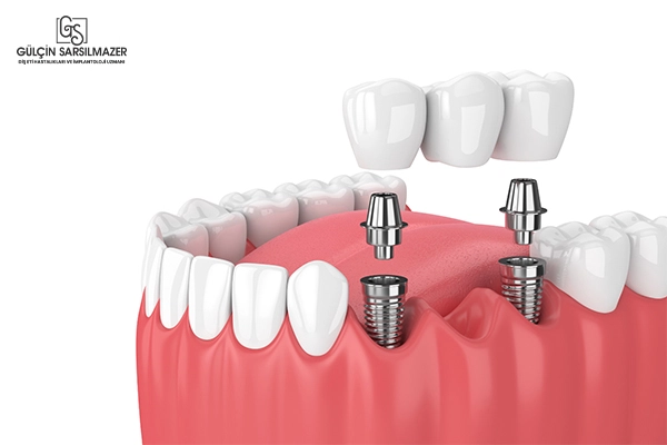 Üç diş eksikliğini gidermek için iki dental implant üzerine yerleştirilen köprü protezi
