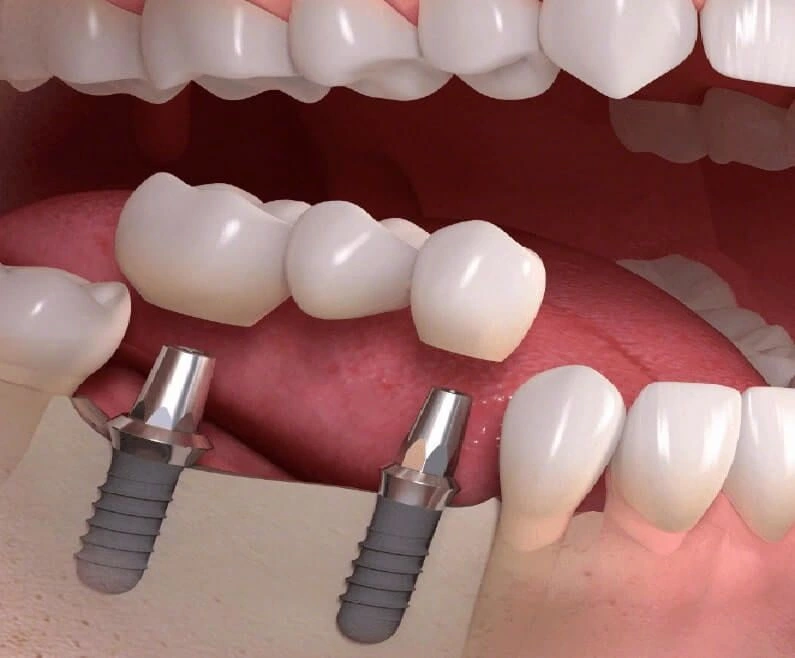 dikişsiz implant tedavisi