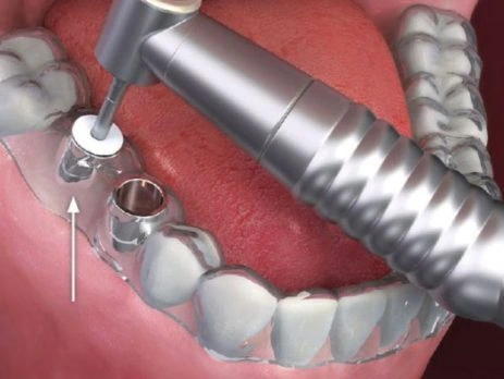 dikişşiz implant