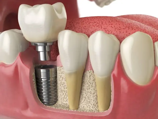 implant tedavisi